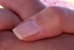 dry cuticle